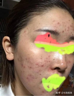 脸颊两侧长小痘痘的原因