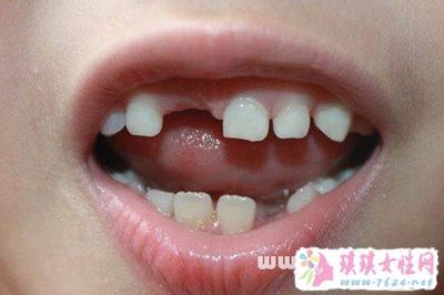 做梦上牙掉了好几颗