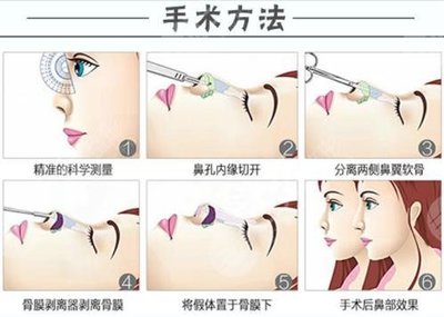 做假体隆鼻取出