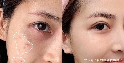 痘痘长一半
