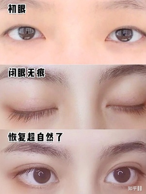 全切埋线哪个好