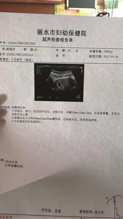 卵巢囊肿怀孕