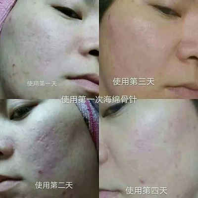 怎么可以让毛孔变小