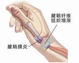 什么是腱鞘炎怎么治疗