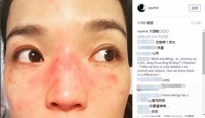 过敏脸肿了是怎么回事
