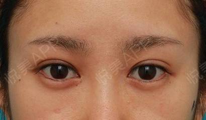 双眼皮做美瞳线好看吗