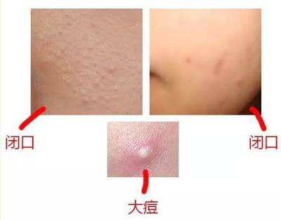 闭口痘痘和闭口粉刺怎么办