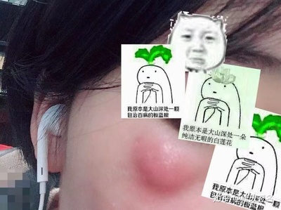 粉瘤和痘痘的区别