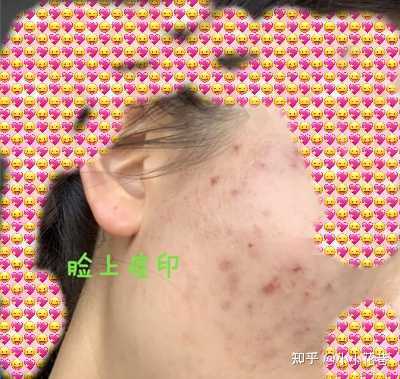 3个痘痘是什么