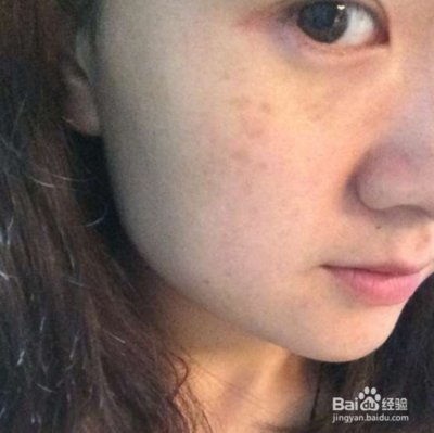 脸颊长斑是怎么回事