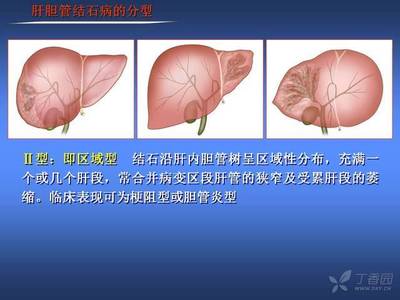 肝管结石怎么治疗最好的方法