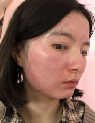 微针祛斑效果怎么样