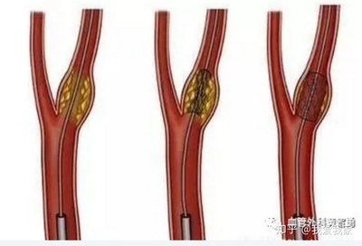 动脉闭塞怎么治疗