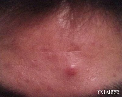 吸完毛孔长痘痘怎么办