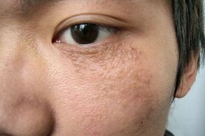 脸上的痘痘忌口鸡么