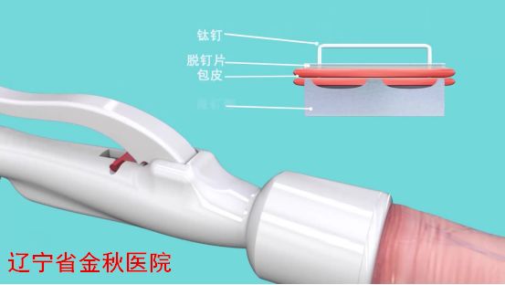 韩式包皮环切
