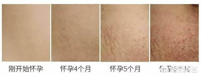 怀孕一个月会长妊娠纹吗