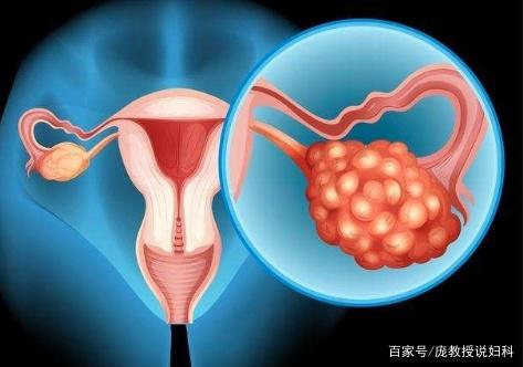 卵巢多囊样改变怎么治疗