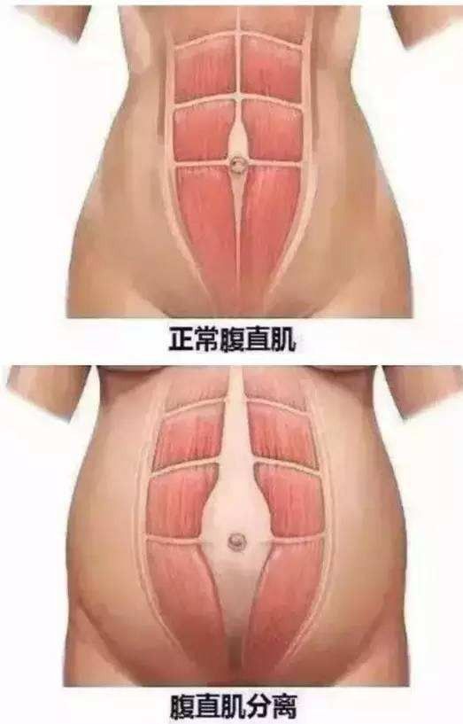 肚子疝气