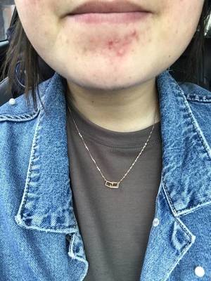 下腭长痘痘