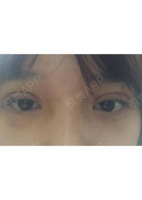 做双眼皮淤青多久能好