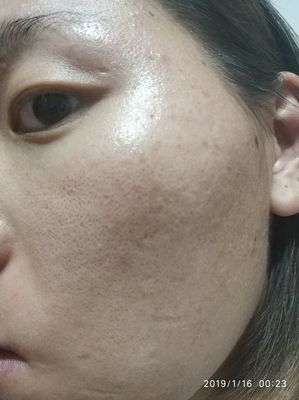 毛孔粗大脸上长痘痘