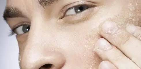 男生经常长痘痘要去角质吗