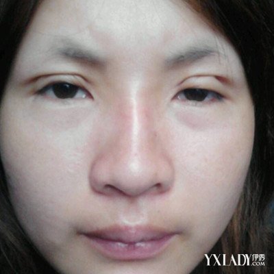 双眼皮会失败吗