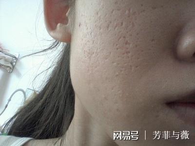 毛孔粗大痘坑