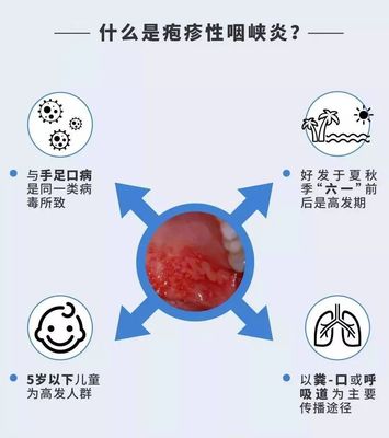 囗腔疱疹怎么治疗