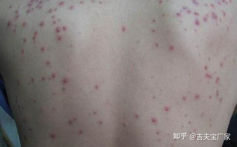 痤疮应该怎么治疗