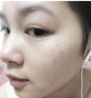 点痣多少钱一颗