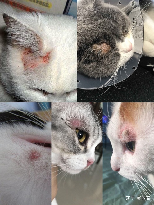 人长猫癣怎么治疗