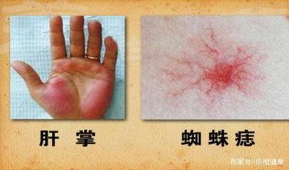 蜘蛛痣怎么治疗