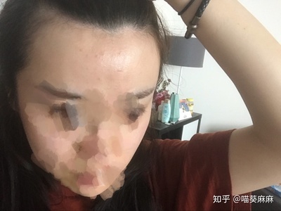 少女额头为何老长痘痘