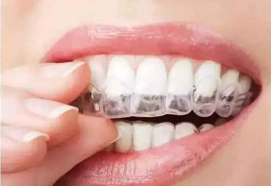 隐形矫正牙齿