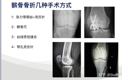 髌骨手术61天能弯多少度