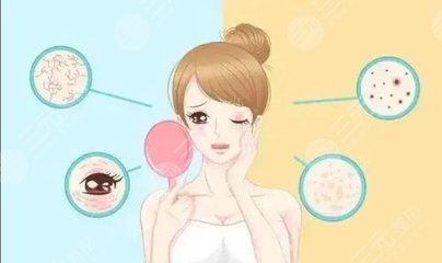 痘印会好吗