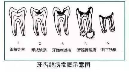 根管治疗怎么治