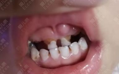 宝宝牙齿痛