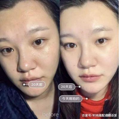 效果最好的美白针