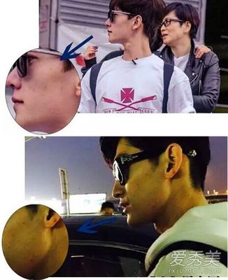 女性鼻翼右侧长痘痘