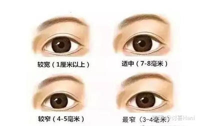 双眼皮割的太窄了