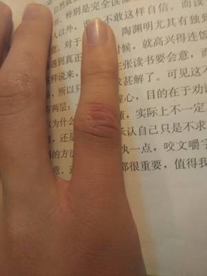 小拇指痛是怎么回事