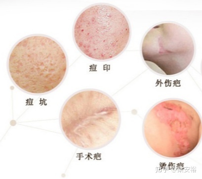除疤痕的方法