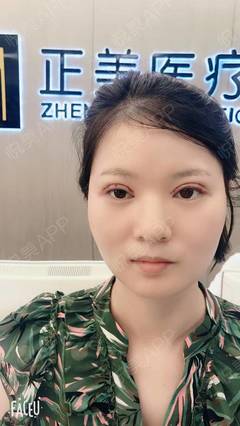 全切双眼皮多久能上班