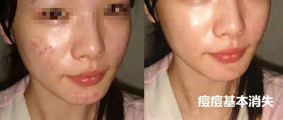 熬夜是不是爱起痘痘