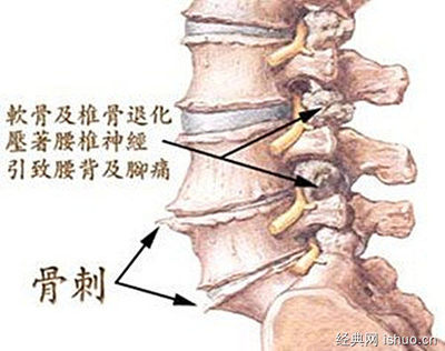 椎间盘膨突出怎么治疗