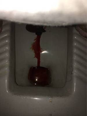 大便出好多血是怎么回事