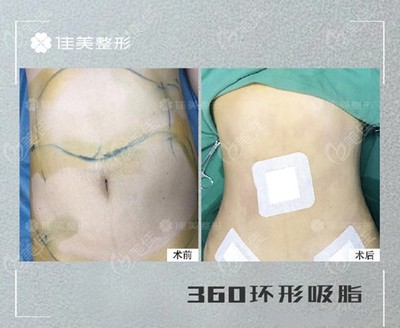 环形抽脂